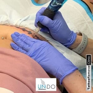 UNDO Tattoo Removal