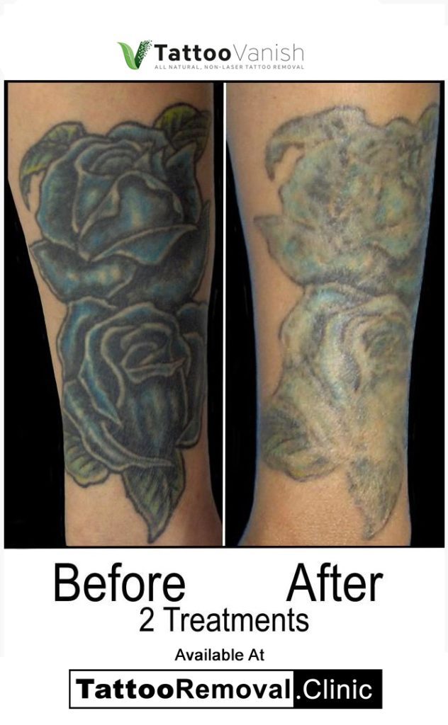 saline tattoo removal before and after Affordable Tattoo Removal