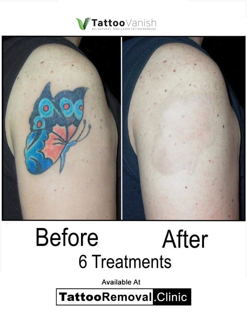 tattoo removal before and after face Affordable Tattoo Removal Clinic