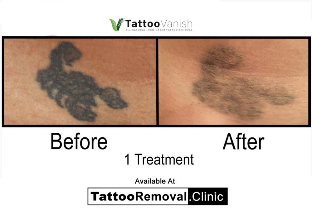 tattoo-removal-before-and-after-pictures-affordable-tattoo-removal