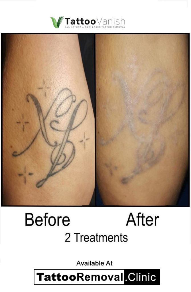 tattoo removal cream before and after Affordable Tattoo Removal