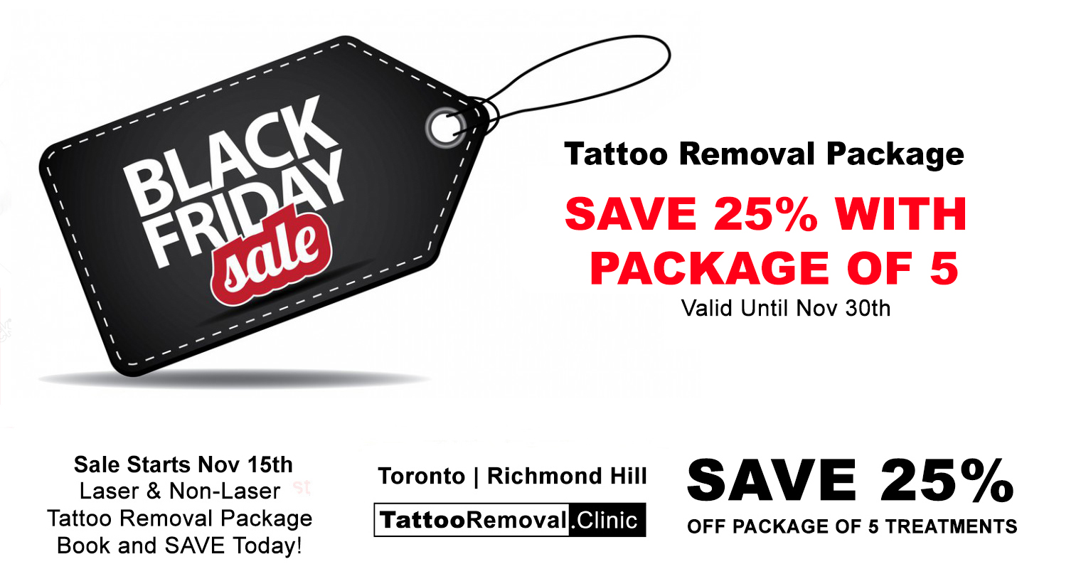 Laser Tattoo Removal Toronto