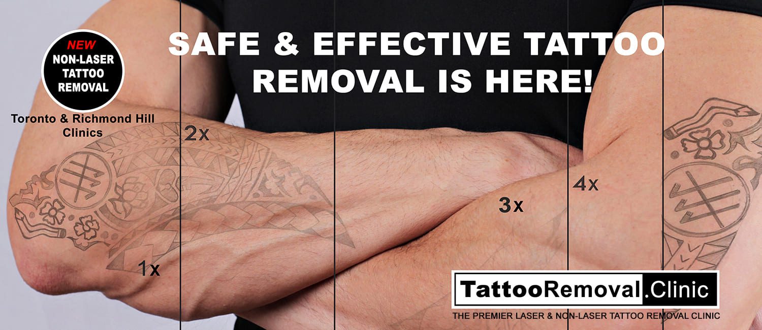 An Overview on Tattoo Vanish Method Tattoo Removal Toronto